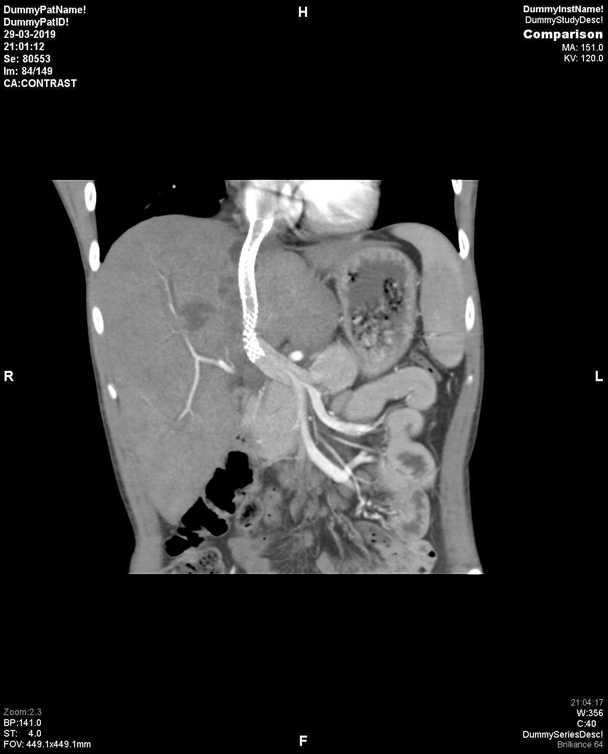 Post procedure CT